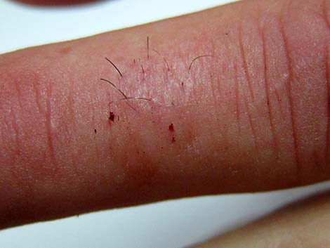 Snakebite, Nov. 29, 2010