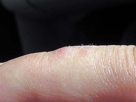 Coral Snake Bite