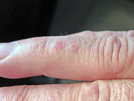Coral Snake Bite